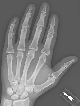 Hand Sesamoid Bone
